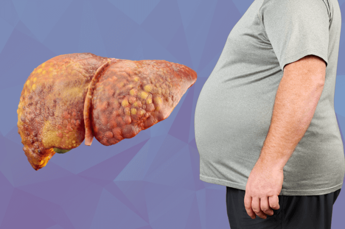 fatty-liver-disease